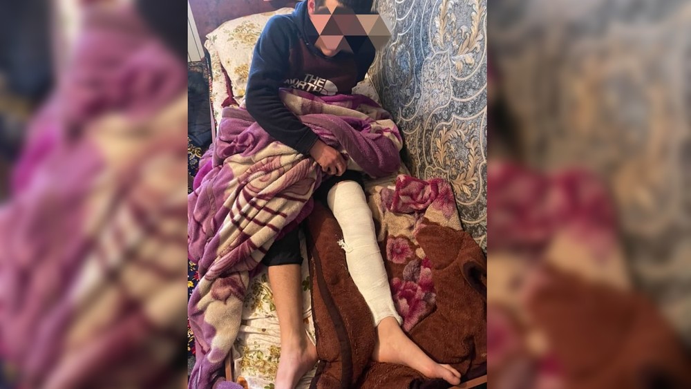 Фото восьмиклассника, получившего перелом ноги в Кара-Суйском районе.