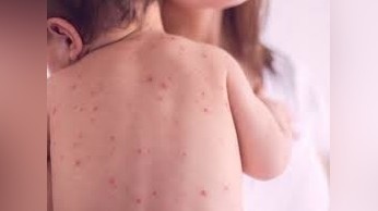 Number of measles cases in Mongolia reaches 13,171