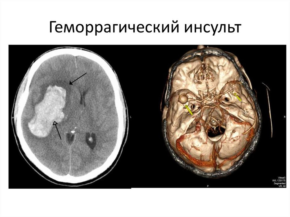 Геморрагический инсульт при мультиспиральной КТ (слева) и при 3D-реконструкции артерий и картины поражения головного мозга