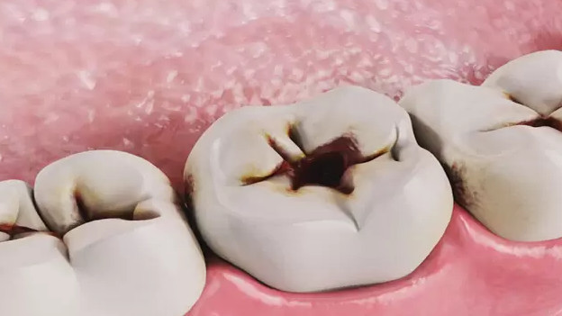 Near-universal tooth decay rates reported among children and adults in Kyrgyzstan