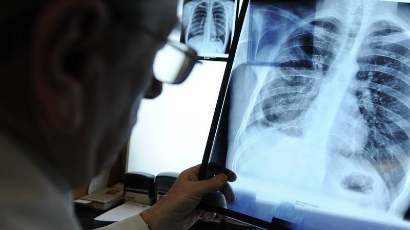 Kyrgyzstan reports significant long-term decline in TB rates