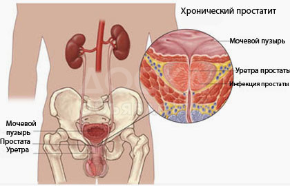 От Простатита