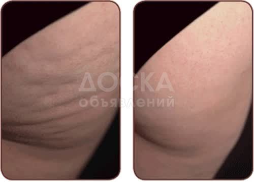 Эффективная борьба с целлюлитом в Бишкеке.