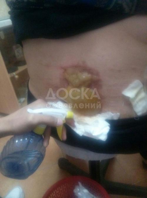 Лечим грыжи :